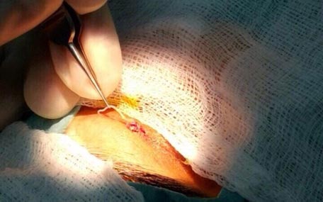 Dubai doctors remove 12cm worm from woman's eyelid