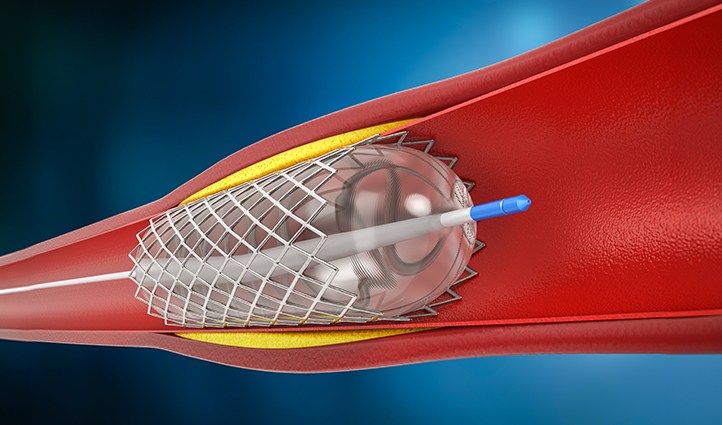 Got a Heart Stent? Here's How to Recover Safely