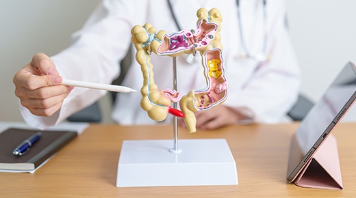 Ulcerative Colitis Management