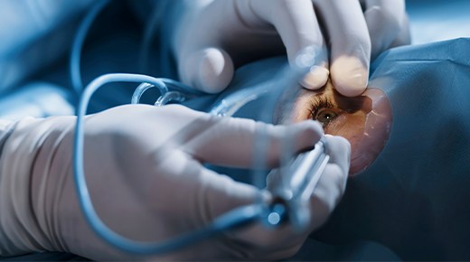 Trabeculectomy
